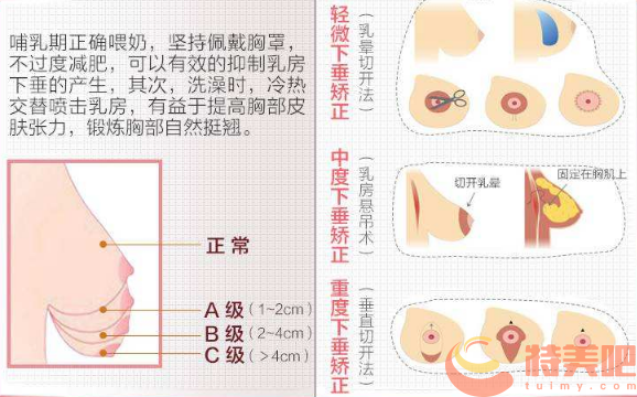 胸下垂