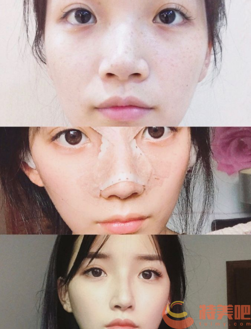 蒜头鼻整形