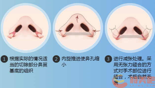 鼻翼缩小示意图