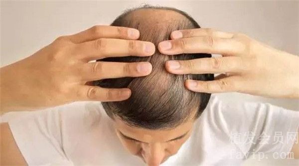 导致季节性脱发的原因是什么？