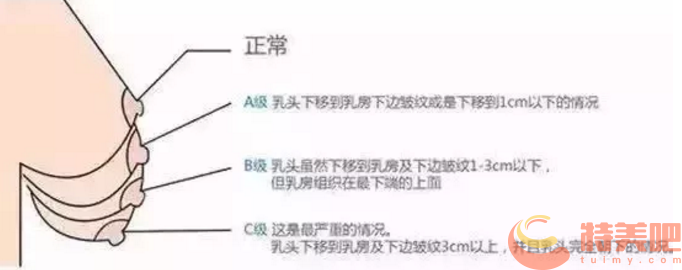 胸下垂程度