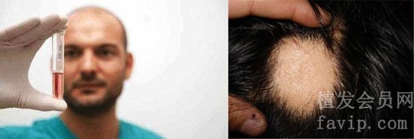 疤痕性脱发和化学性脱发有什么区别？