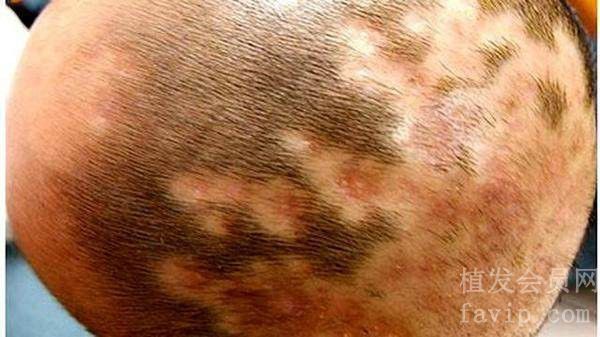 预防感染性脱发的方法有哪些？