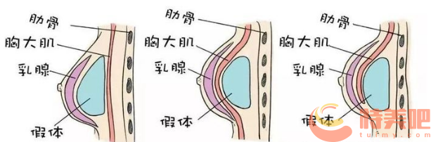 假体隆胸位置