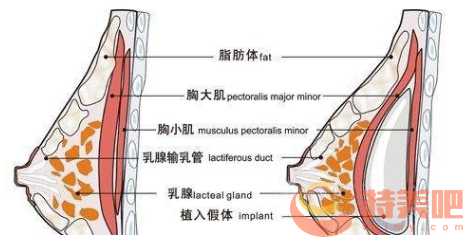 隆胸假体在胸大肌后