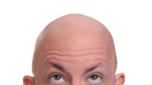 秃头为什么男性比女性更严重？