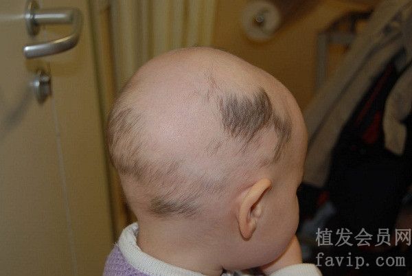 小孩斑秃的原因是什么？