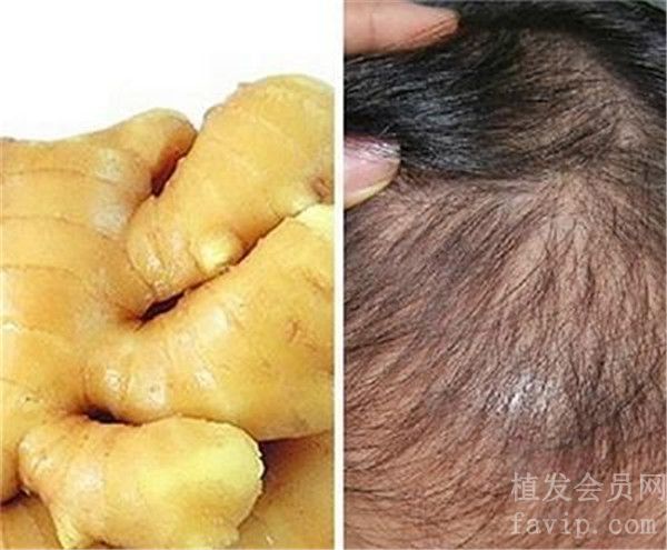 生姜能治疗脂溢性脱发吗？