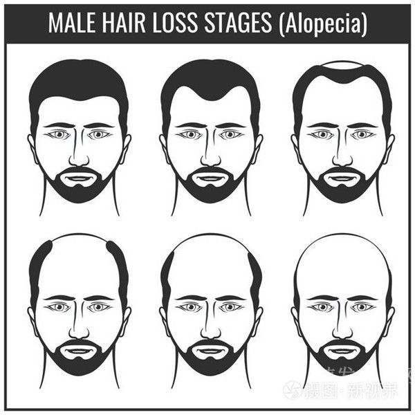 九种常见的脱发类型，来看看你是哪一种？