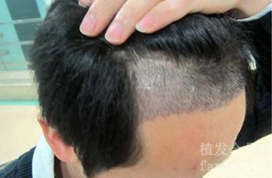 成都青羊丝缘毛发医疗美容门诊部头发种植多久才能看到理想效果