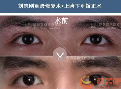 刘志刚医生双眼皮修复案例1