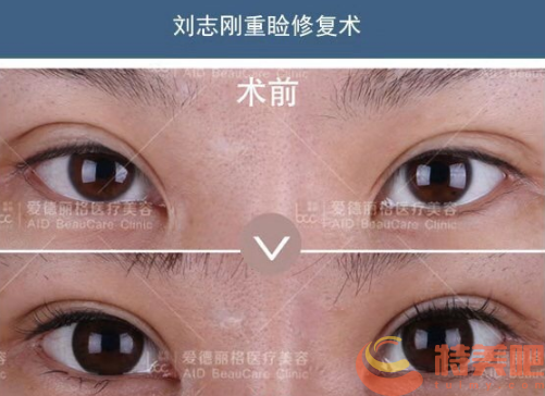 刘志刚医生双眼皮修复案例2