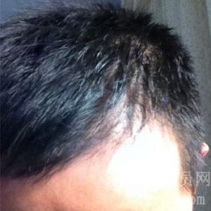 [雄性脱发] 即将开始使用经典组合