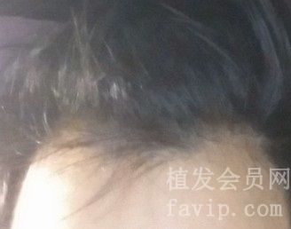 一边额头发际线上移，怎么办，大家支支招吧