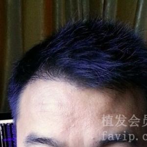 植发半年多了，看看我的效果吧！