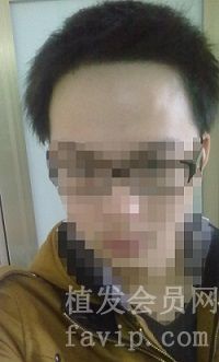 我这个发际线怎么办啊？天生好像就是这样
