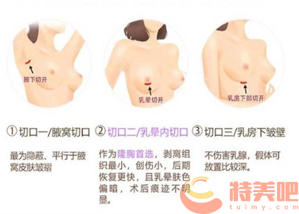 假体隆胸三种切口位置