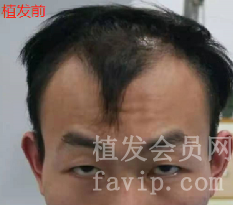在广州已经做了植发手术，总结手术前前后后的经验
