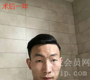 在广州已经做了植发手术，总结手术前前后后的经验