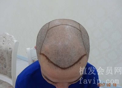 6级脱发，我在郑州育发植发研究院做完植发四年了！