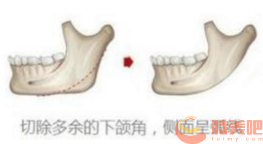 上海下颌角磨骨示意图