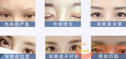 杭州双眼皮修复