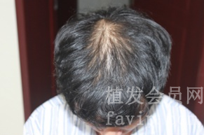 北京头顶加密植发价格贵吗？