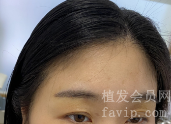 广州做了植眉手术后，眉形非常好看！