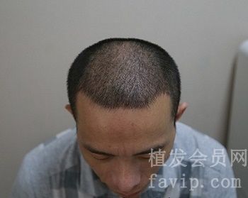 广州科发源植发，效果很好。
