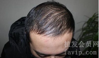 北京科发源种植头发后的蜕变