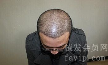 北京科发源种植头发后的蜕变