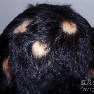 神经性脱发是什么？