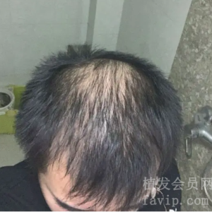 脱发好几年，做植发能保持多久呢？