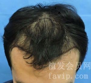北京植发：脱发很多年了，*终决定去植发，共植发3500个单位。