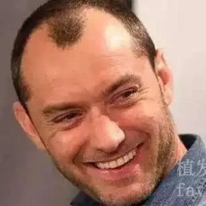 发际线高做植发需要多少钱？