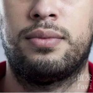 胡须种植术后，多久可以刮胡子？