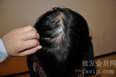 女性脂溢性脱发怎么治疗更有效？