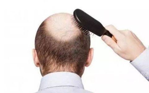 用米诺地尔额头长出绒毛会变成头发吗？