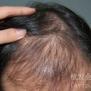 种植头发有危害吗？