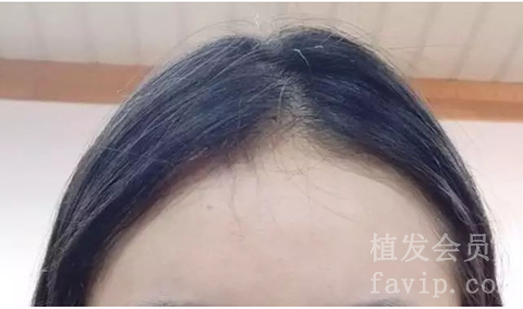 发际线植发多久能化妆？