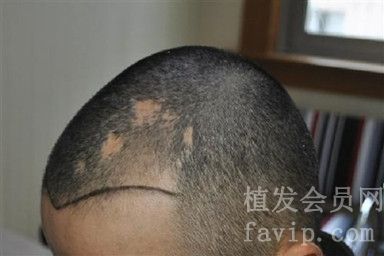 疤痕要多久才可以植发？
