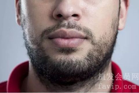 种植胡须后多久可以正常刮？