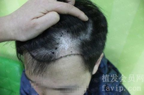 柳州正规的植发医院有哪些？