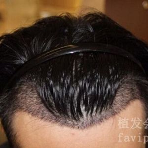 杭州头发种植多少钱？