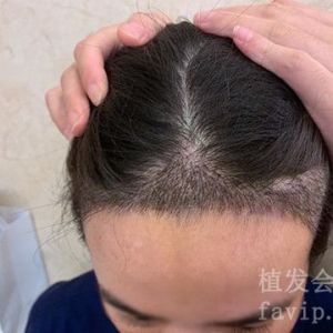 深圳头发种植大概要多少钱？