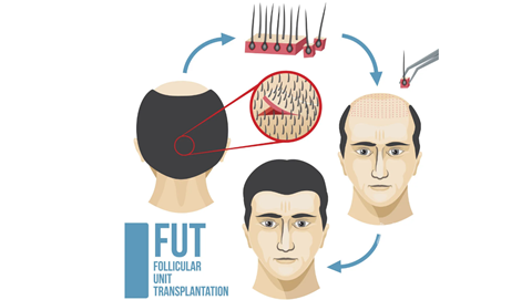 做FUT植发后的效果看起来自然吗？