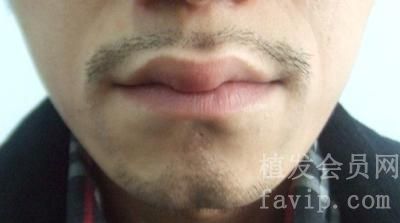 在上海种植胡须的费用是多少？