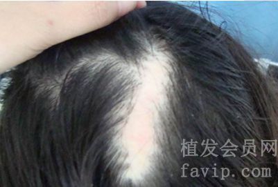 头顶烧伤的圆疤可以植发吗？