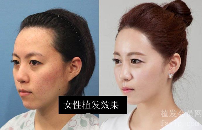 惠州正规植发医院排行榜前十名有哪些？