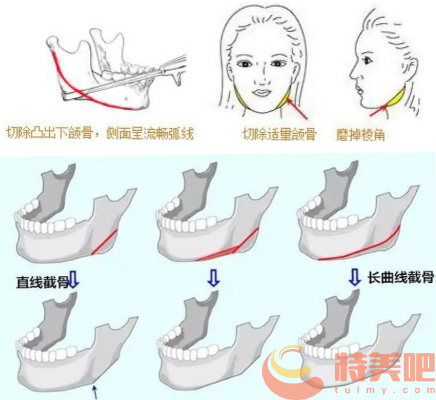 下颌角截骨